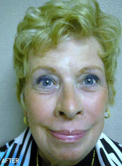 Skin-Rejuvenation-Patient-02 | After Skin Rejuvenation