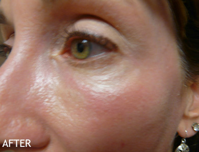 Skin-Rejuvenation-Patient-03 | After Skin Rejuvenation