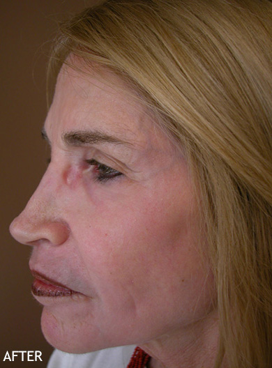 Skin-Rejuvenation-Patient-04 | After Skin Rejuvenation