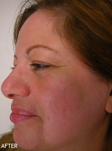Skin-Rejuvenation-Patient-05 | After Skin Rejuvenation