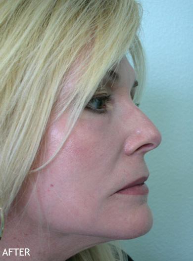 Skin-Rejuvenation-Patient-06 | After Skin Rejuvenation