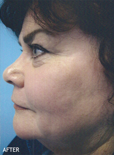 Skin-Rejuvenation-Patient-07 | After Skin Rejuvenation