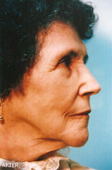 Skin-Rejuvenation-Patient-08 | After Skin Rejuvenation