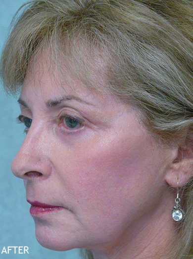 Skin-Rejuvenation-Patient-09 | After Skin Rejuvenation