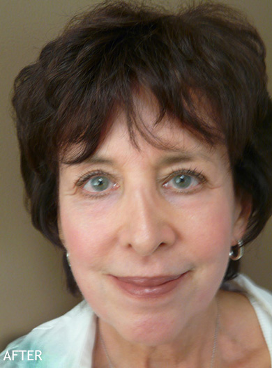 Skin-Rejuvenation-Patient-10 | After Skin Rejuvenation