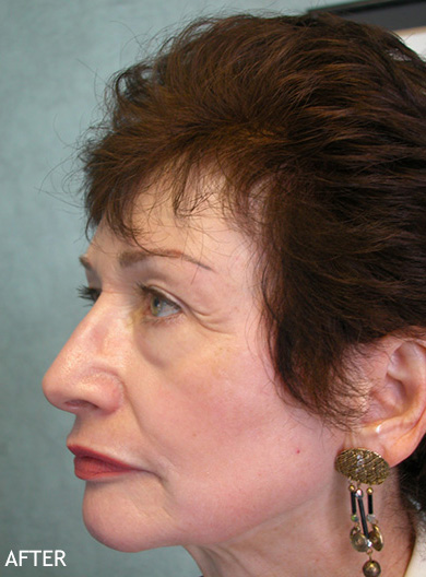 Skin-Rejuvenation-Patient-11 | After Skin Rejuvenation