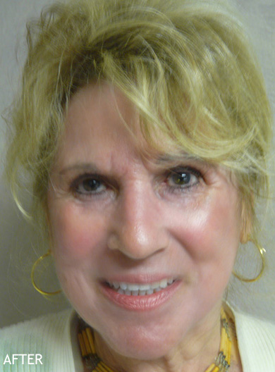 Skin-Rejuvenation-Patient-12 | After Skin Rejuvenation