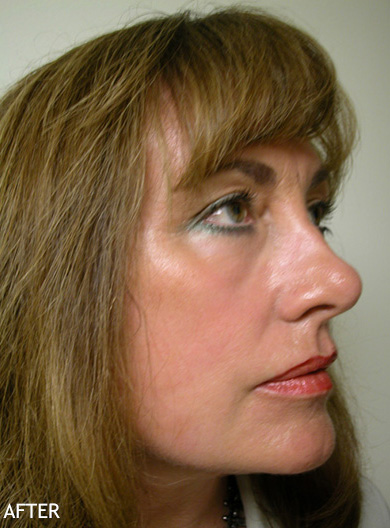 Skin-Rejuvenation-Patient-13 | After Skin Rejuvenation