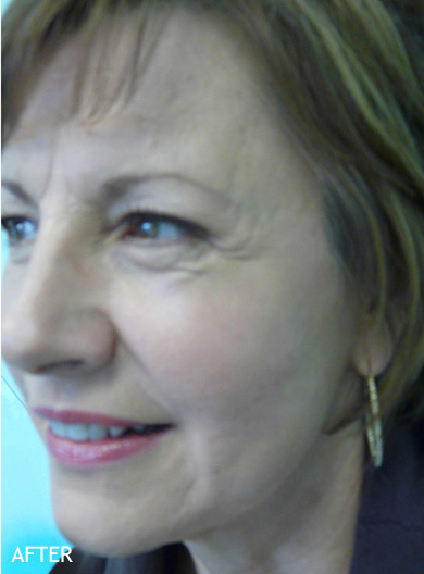 Skin-Rejuvenation-Patient-14 | After Skin Rejuvenation