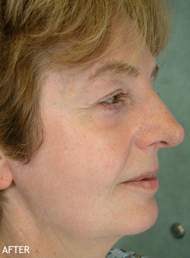 Skin-Rejuvenation-Patient-15 | After Skin Rejuvenation