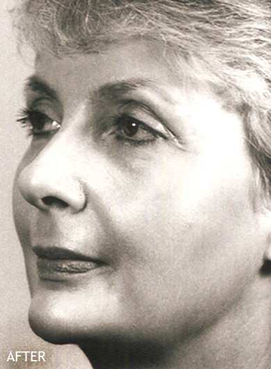 Skin-Rejuvenation-Patient-16 | After Skin Rejuvenation