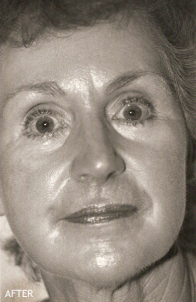 Skin-Rejuvenation-Patient-17 | After Skin Rejuvenation