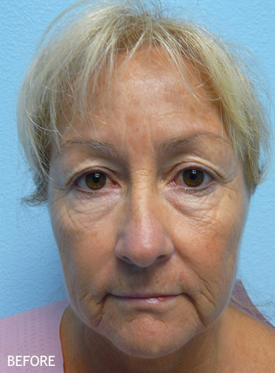 Skin-Rejuvenation-Patient-01 | Before Skin Rejuvenation