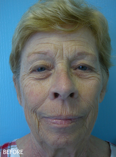 Skin-Rejuvenation-Patient-02 | Before Skin Rejuvenation