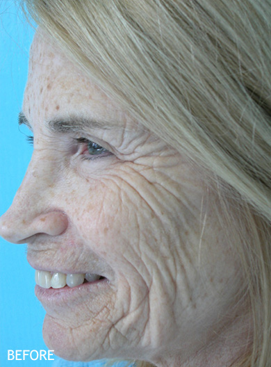 Skin-Rejuvenation-Patient-04 | Before Skin Rejuvenation