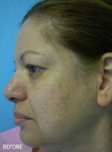 Skin-Rejuvenation-Patient-05 | Before Skin Rejuvenation