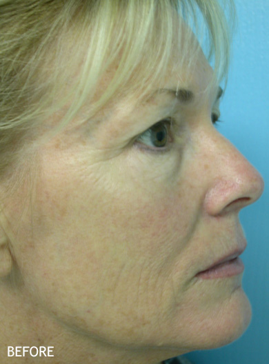 Skin-Rejuvenation-Patient-06 | Before Skin Rejuvenation