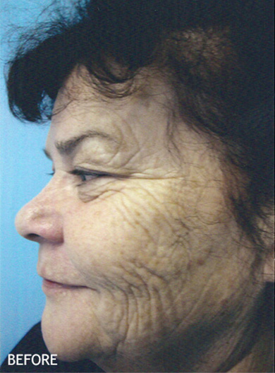Skin-Rejuvenation-Patient-07 | Before Skin Rejuvenation