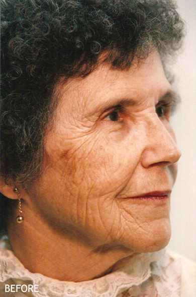 Skin-Rejuvenation-Patient-08 | Before Skin Rejuvenation