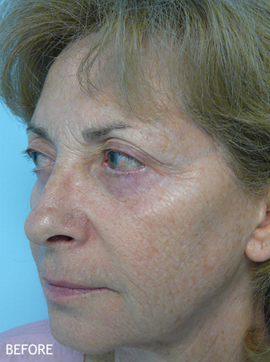 Skin-Rejuvenation-Patient-09 | Before Skin Rejuvenation