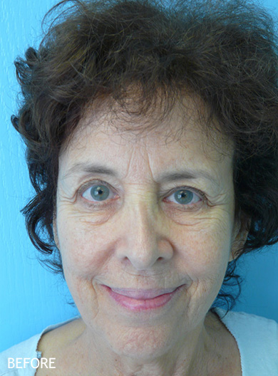 Skin-Rejuvenation-Patient-10 | Before Skin Rejuvenation