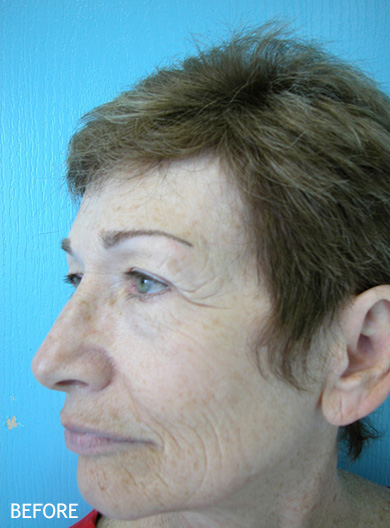 Skin-Rejuvenation-Patient-11 | Before Skin Rejuvenation