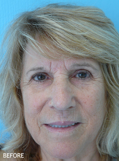 Skin-Rejuvenation-Patient-12 | Before Skin Rejuvenation