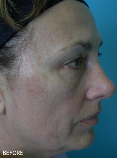 Skin-Rejuvenation-Patient-13 | Before Skin Rejuvenation