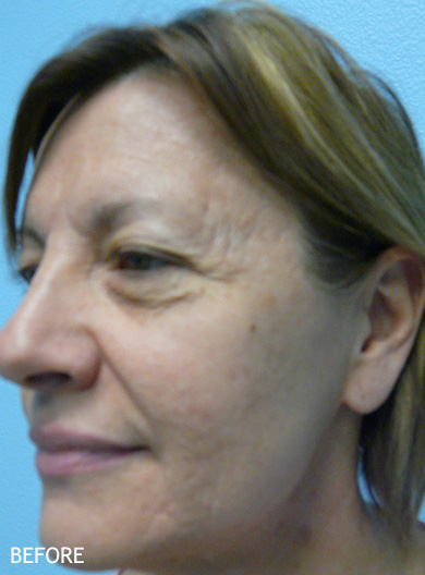 Skin-Rejuvenation-Patient-14 | Before Skin Rejuvenation