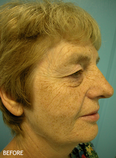 Skin-Rejuvenation-Patient-15 | Before Skin Rejuvenation