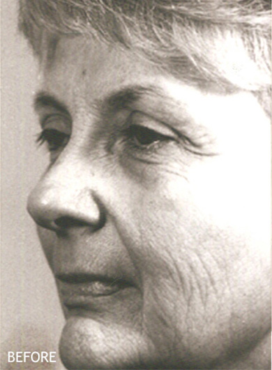 Skin-Rejuvenation-Patient-16 | Before Skin Rejuvenation