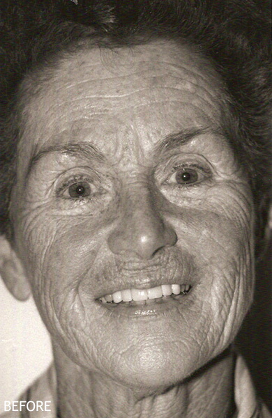 Skin-Rejuvenation-Patient-17 | Before Skin Rejuvenation