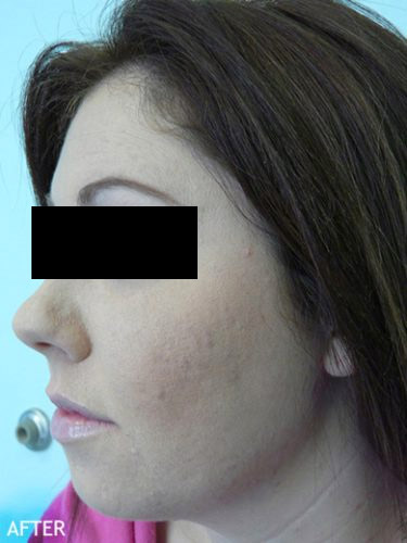 SmartLipo--x2122--Patient-01 | After SmartLipo™