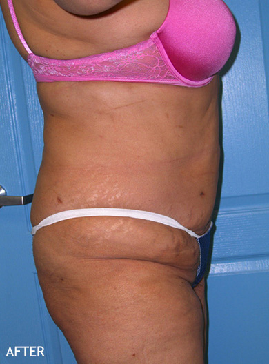 SmartLipo--x2122--Patient-04 | After SmartLipo™