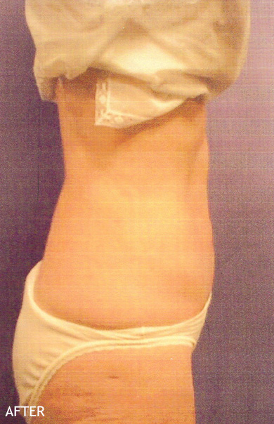 SmartLipo--x2122--Patient-05 | After SmartLipo™