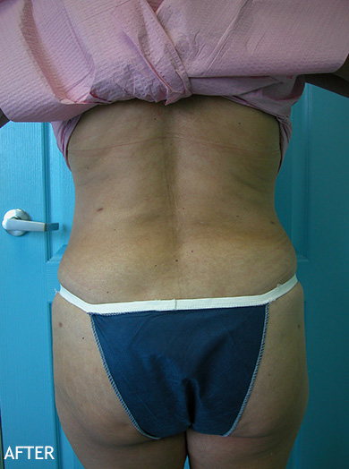 SmartLipo--x2122--Patient-09 | After SmartLipo™