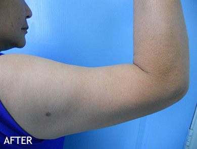 SmartLipo--x2122--Patient-10 | After SmartLipo™