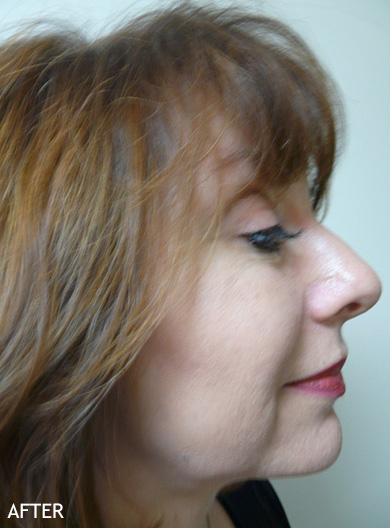 SmartLipo--x2122--Patient-11 | After SmartLipo™