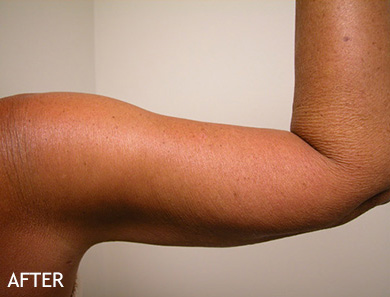 SmartLipo--x2122--Patient-12 | After SmartLipo™