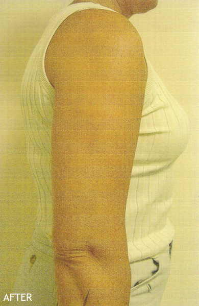 SmartLipo--x2122--Patient-13 | After SmartLipo™
