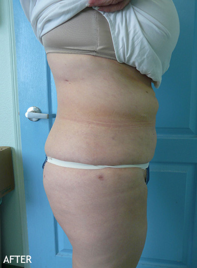 SmartLipo--x2122--Patient-14 | After SmartLipo™