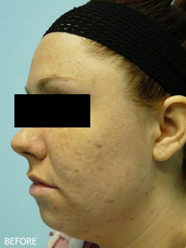 SmartLipo--x2122--Patient-01 | Before SmartLipo™