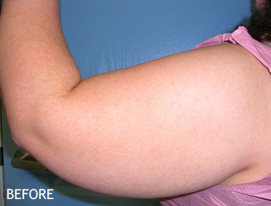 SmartLipo--x2122--Patient-02 | Before SmartLipo™