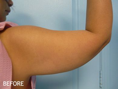 SmartLipo--x2122--Patient-03 | Before SmartLipo™