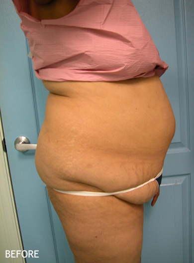 SmartLipo--x2122--Patient-04 | Before SmartLipo™