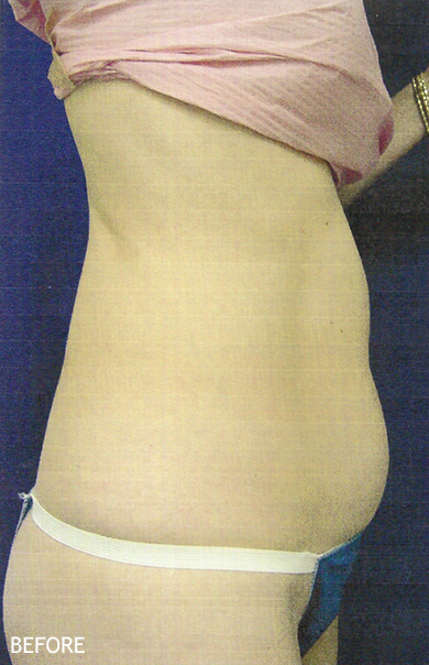 SmartLipo--x2122--Patient-05 | Before SmartLipo™