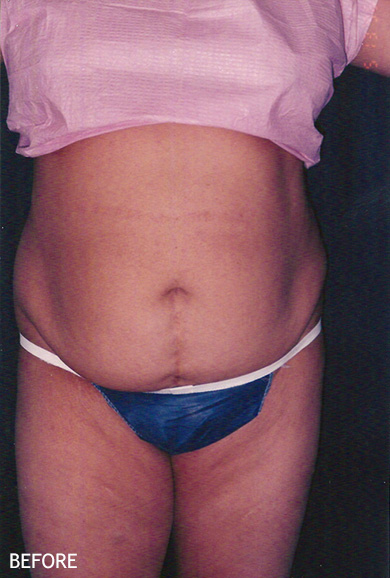 SmartLipo--x2122--Patient-07 | Before SmartLipo™