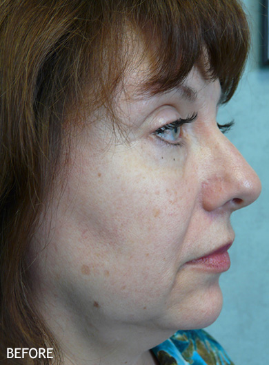 SmartLipo--x2122--Patient-11 | Before SmartLipo™