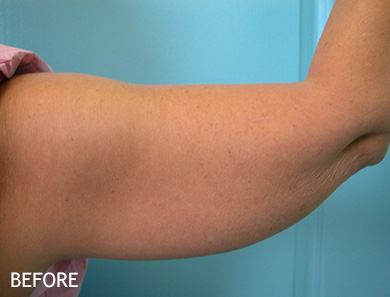 SmartLipo--x2122--Patient-12 | Before SmartLipo™