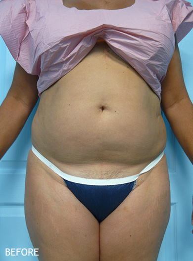 SmartLipo--x2122--Patient-15 | Before SmartLipo™